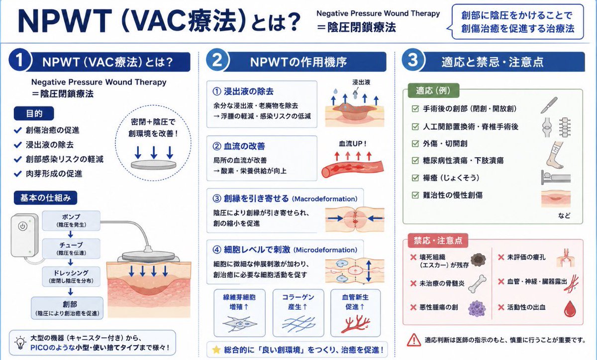 tsui_pt's tweet photo. 【NPWT（VAC療法）とは？】

NPWT（別名VAC療法・陰圧閉鎖療法）は👇

✅ 浸出液の除去
✅ 浮腫の軽減
✅ 血流改善
✅ 肉芽形成促進
✅ 創部合併症リスク低減

などを目的に使用されます。

人工関節置換術や脊椎手術後に使用される機会も増えており、理学療法士や看護師にとっても理解しておきたい治療のひとつです。

今回は
🔹NPWTとは？
🔹作用機序
🔹適応・禁忌

について1枚にまとめました👇

臨床で見かけるけど詳しくは知らなかったという方は、ぜひ画像をご覧ください！