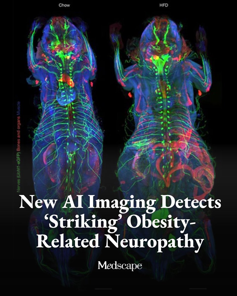 Medscape's tweet photo. GLP-1 receptor agonists are being prescribed to tens of millions of patients with obesity. What no one can yet answer is whether those drugs are protecting their peripheral nerves or damaging them further. Small clinical studies suggest GLP-1 receptor agonists may improve nerve structure in patients with diabetic neuropathy, yet other studies document cases where patients develop peripheral neuropathy because of rapid weight loss due to GLP-1 drugs.

That question gained new urgency with a recently published Nature study. A team at Helmholtz Munich in Oberschleißheim, Germany, used an AI system called MouseMapper to scan every nerve, immune cell, and 31 organs in a transparent mouse body — all at once. What they found suggests obesity-associated nerve damage extends far beyond the extremities where clinicians typically measure it. Read more on the study: https://t.co/PnEaru6ME5