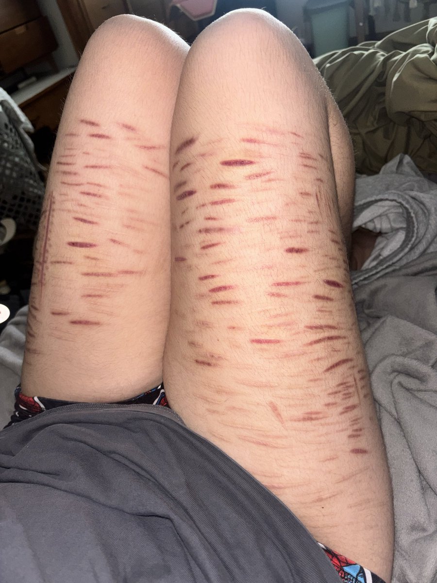 Grayson2hdx's tweet photo. My scars atm
#shedtwt https://t.co/u00087ZzPq