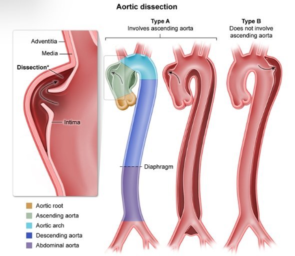 TrackYourHeart's tweet photo. Which connective tissue disorder is strongly associated with aortic dissection?
a) Turner syndrome
b) Klinefelter syndrome
c) Marfan syndrome
d) Down syndrome https://t.co/PuwW8cQiic