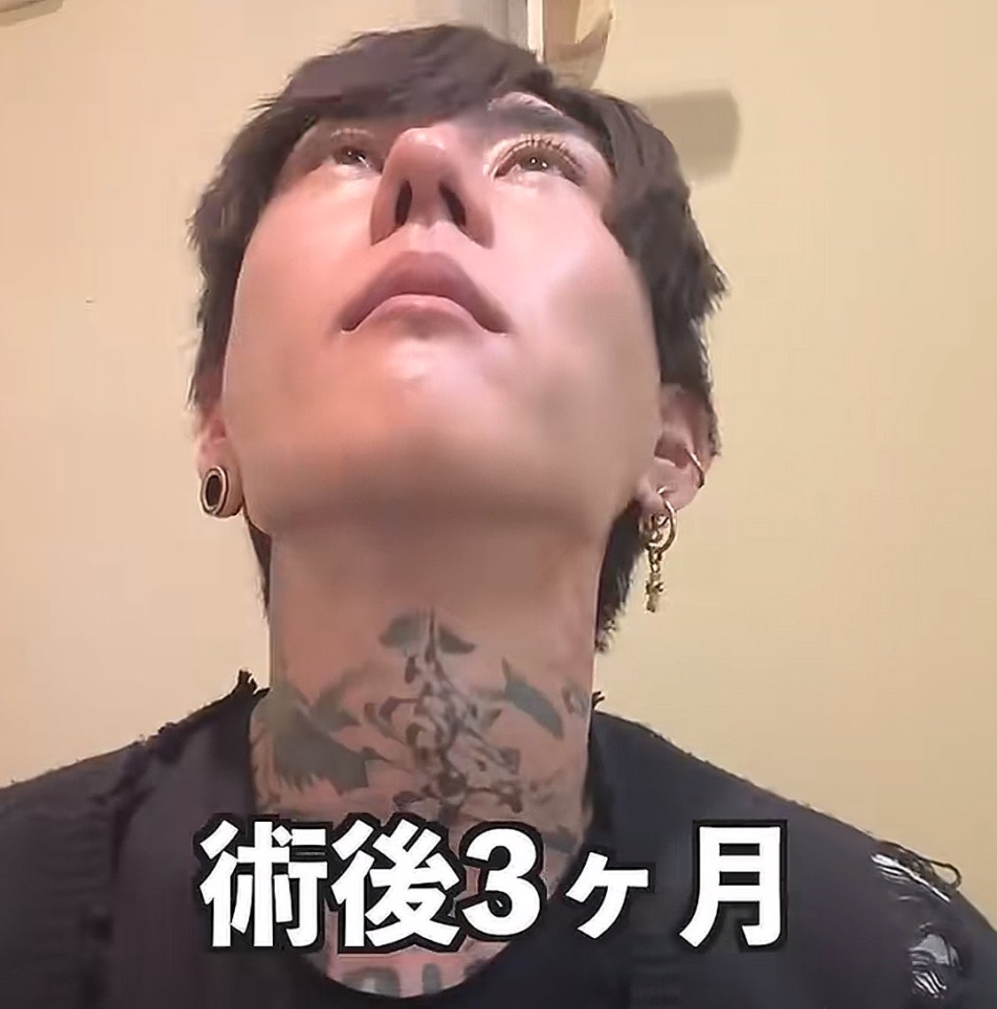 motiva55's tweet photo. 【悲報】YouTuberさん、韓国NANA美容外科で鼻整形をするも無惨なお姿になら��る

粗雑なプロテーゼを入れた事で眉間部がアバター化し、鼻尖部軟骨移植では鼻の穴もピンチノーズになり、鼻もタケノコみたいに曲がって生えてしまう。

日本人マーケ病院は🍐だと痛感した事件なのであった。 https://t.co/lOQHwWdHqh