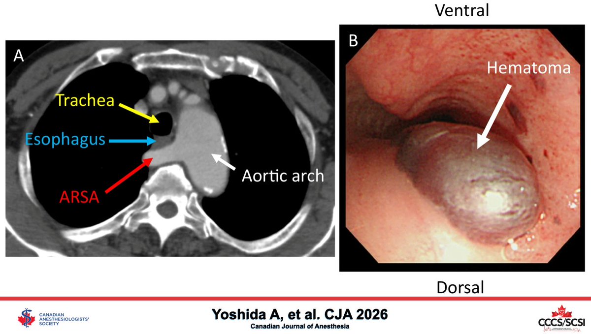 CASUpdate's tweet photo. Submucosal hematoma after transesophageal echocardiography in a patient with an aberrant right subclavian artery - Canadian Journal of Anesthesia 

Access online - https://t.co/CJpkqLcF7o

@CJA_Journal

#PatientCare #CanadianJournalOfAnesthesia #CJA2026 https://t.co/xNP44yk8Hj