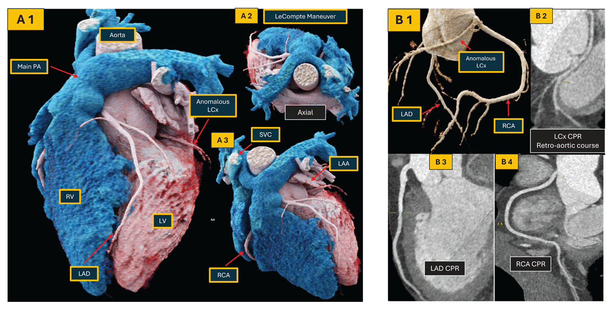 DeBakeyCVedu's tweet photo. TTE is the first-line tool for initial evaluation, but CMR &amp; CT are frequently needed for comprehensive assessment.

The Initial Diagnostic Approach to ACHD: A Practical Imaging Pathway - @aliciarangosch @AneeshDhore @valeriaduarteMD

https://t.co/5ZKdMZ4uf6
#DeBakeyCVJournal https://t.co/z7nfqzFHVN