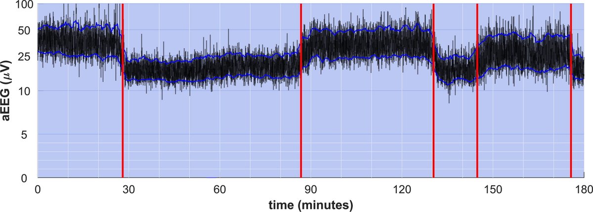 ClinicalNeuroph's tweet photo. [Critical Care EEG] van der Steen et al.: "This work explores the role of amplitude-integrated electroencephalography as a tool to characterize sleep-wake cycling." https://t.co/yVXF7fmCda https://t.co/W4jx2Vk9z9