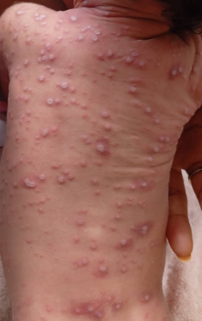 AnneNjom's tweet photo. Cas de Mpox néonatal, Bb de 14 jours dans la ville de Douala
■Issue finale: décès
■Mesures de santé publique préventive en cours par la vaccination du personnel de santé et des communautés
#Mpox
#MpoxAwareness
#EmergingDiseases https://t.co/UINXLtY1g2
