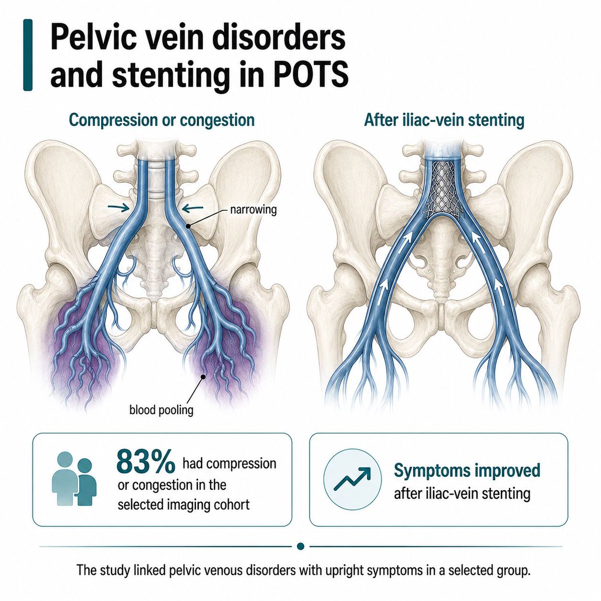 JackHadfield14's tweet photo. In a selected group with POTS or other upright symptoms plus signs of pelvic vein disease, 83% had pelvic vein compression or congestion. In a larger, partly overlapping group of 271 women, symptoms and quality of life improved after stenting. https://t.co/pxVN6zrbyv