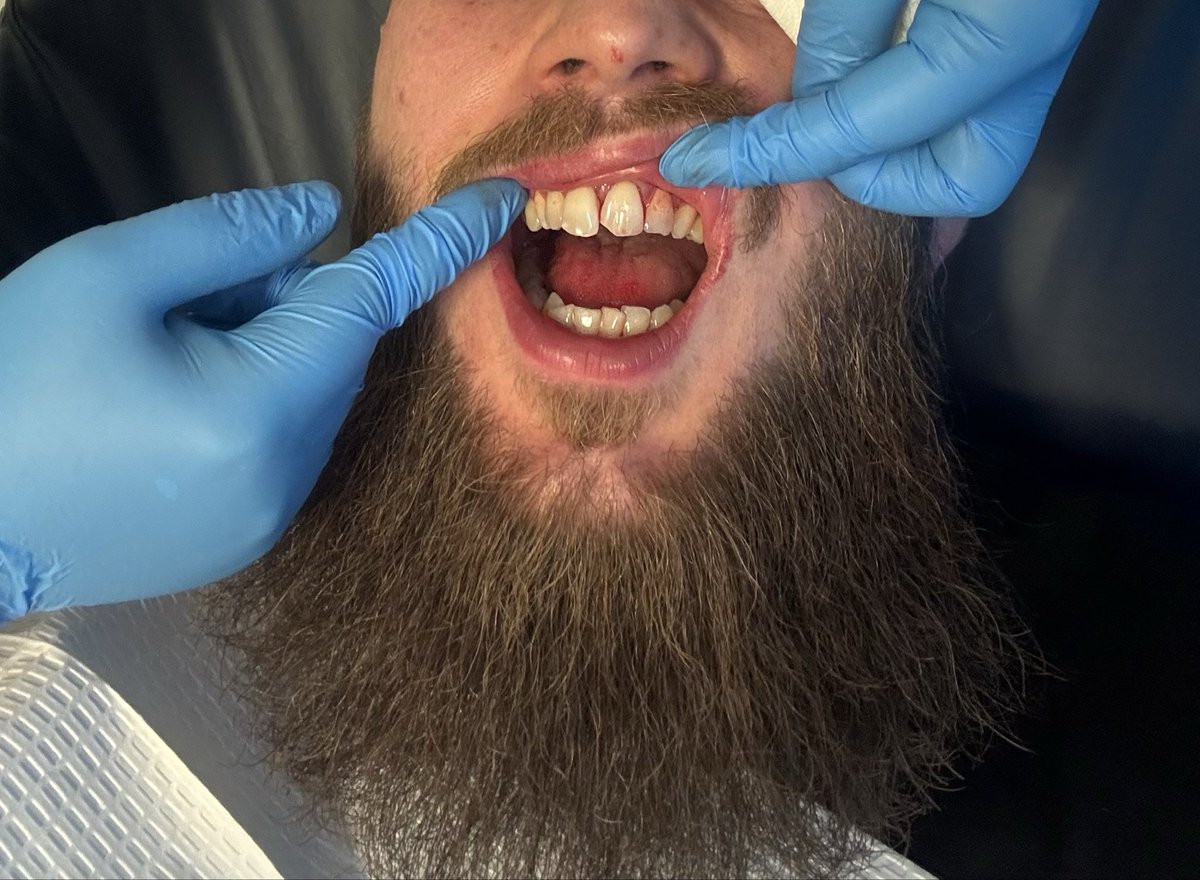 fxckingham's tweet photo. Falling and smashing my teeth 4 days before Manchester was not on the cards at all, ripped out one tooth and pushed 3 back, BMTH is gonna be so much fun… 

Second image is how the first hospital put it in and left it until I went to a different hospital to get it done better… https://t.co/BDxYzNkGZN