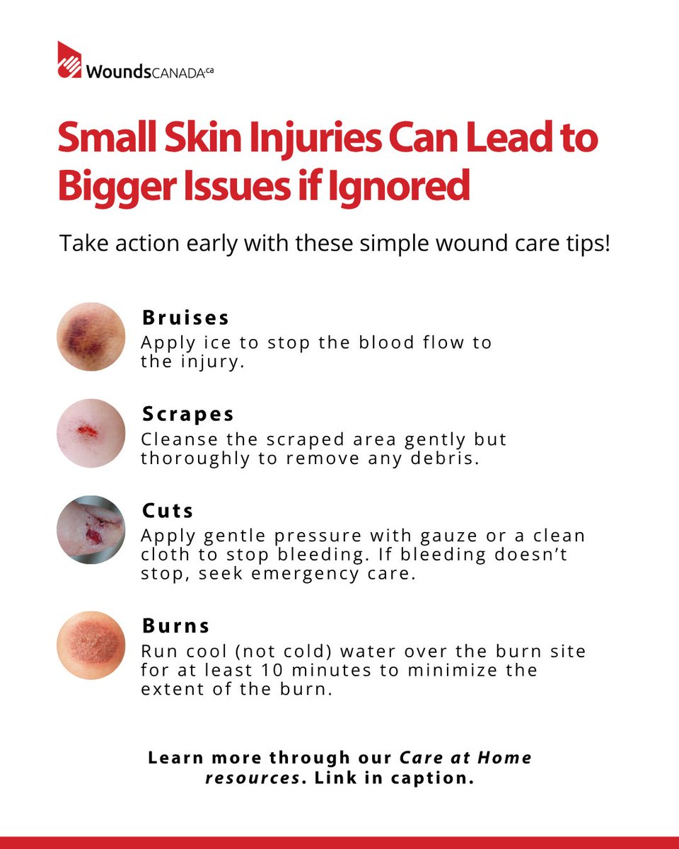 WoundsCanada's tweet photo. Minor cuts can become major problems—especially for people living with diabetes. Don’t ignore small skin injuries this summer.

Learn how to prevent and manage them here:

#SummerSkinHealth https://t.co/Q1J8lBTrQp