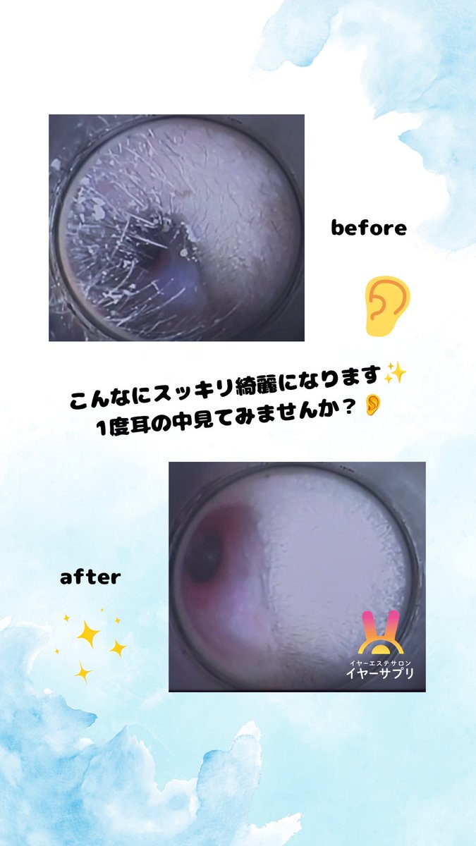 akemi_earsapuri's tweet photo. 本日もご来店ありがとうございました☺️

before→afterです😊

・耳掃除が苦手な人
・耳が痒い人
・耳の中見てみたい人

滋賀県でも耳かき専門店やってます՞⸝⸝>  ̫ <⸝⸝՞👍🏻💞
下記公式LINEよりご予約お待ちしてます🥰
https://t.co/Jf00qXnDof

#耳かき  #耳掃除  #耳かき専門店 
#滋賀  #東近江 https://t.co/YcA14UJO00