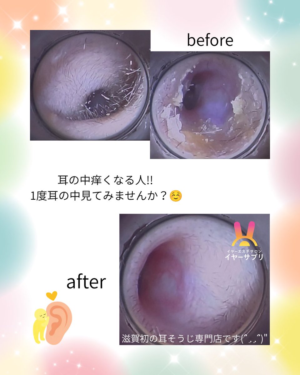 akemi_earsapuri's tweet photo. 本日もご来店ありがとうございました☺️

before→afterです😊

・耳掃除が苦手な人
・耳が痒い人
・耳の中見てみたい人

滋賀県でも耳かき専門店やってます՞⸝⸝>  ̫ <⸝⸝՞👍🏻💞
下記公式LINEよりご予約お待ちしてます🥰
https://t.co/Jf00qXnDof

#耳かき  #耳掃除  #耳かき専門店 
#滋賀  #東近江 https://t.co/YcA14UJO00