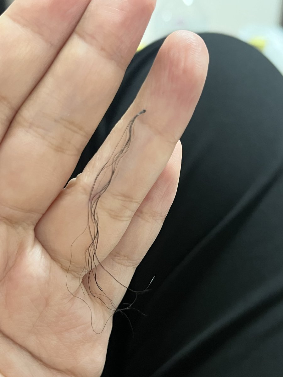 kosatosgn's tweet photo. ちょっと気持ち悪くて閲覧注意なんだけど、
１つの毛穴(？)からめっちゃ縮れた毛が10本くらい束になって伸びてた...。

6センチくらい有るから、きっと去年の年末前からのストレスなんだと思う。

ストレスで円形脱毛症じゃなくて、過剰に生えるパターンもあるのね🫠 https://t.co/bYR5h1cmSP