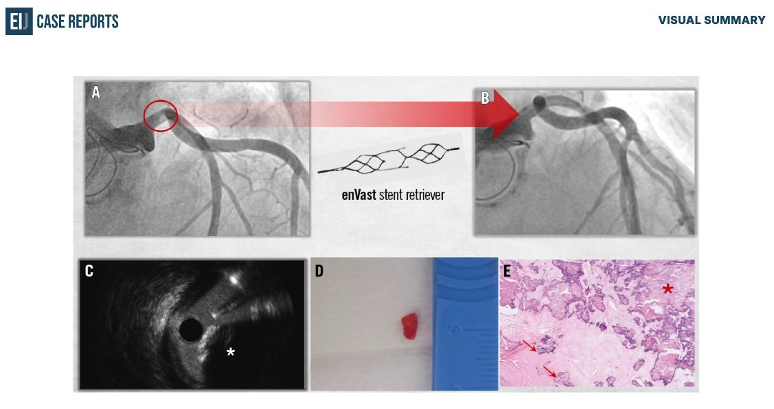 EIJCaseReports's tweet photo. 🫀What would you do if a calcified embolus occluded the left main after #SAVR?
@jfbulnes et al. present the #EuroPCR 2026 Best Clinical Case Award winner, featuring the first successful retrieval using a stent retriever.
🔗Read now: https://t.co/mFyyDEoQMs
#CardioTwitter https://t.co/M1OTTGWPlK