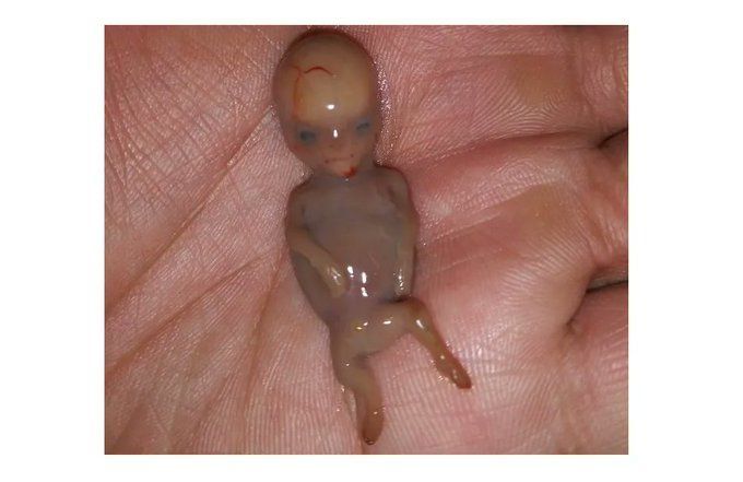 StevenErtelt's tweet photo. This is a baby miscarried at 14 weeks.

This is who abortion kills. https://t.co/D7fI0vWVHi