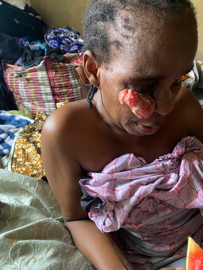 ElizabethAbori3's tweet photo. Please help us save my mum. 🙏🏾
Her cancer surgery was successful, but she urgently needs radiotherapy to stop the cancer from progressing. The cost is beyond what we can afford alone. Any support, donation, or repost can make a difference. Please help us save her life https://t.co/l13EBECU5m