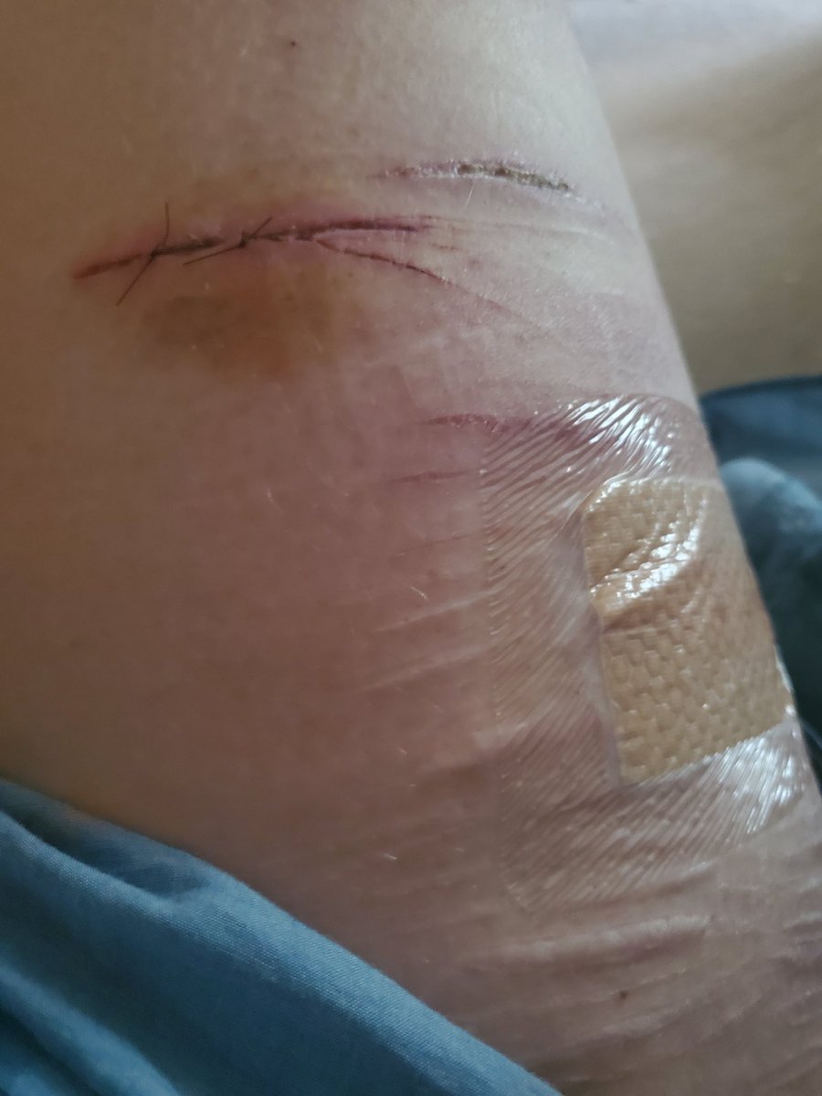 SOSbliss's tweet photo. Legs rn in different stages if healing https://t.co/kCVhvbSNU5