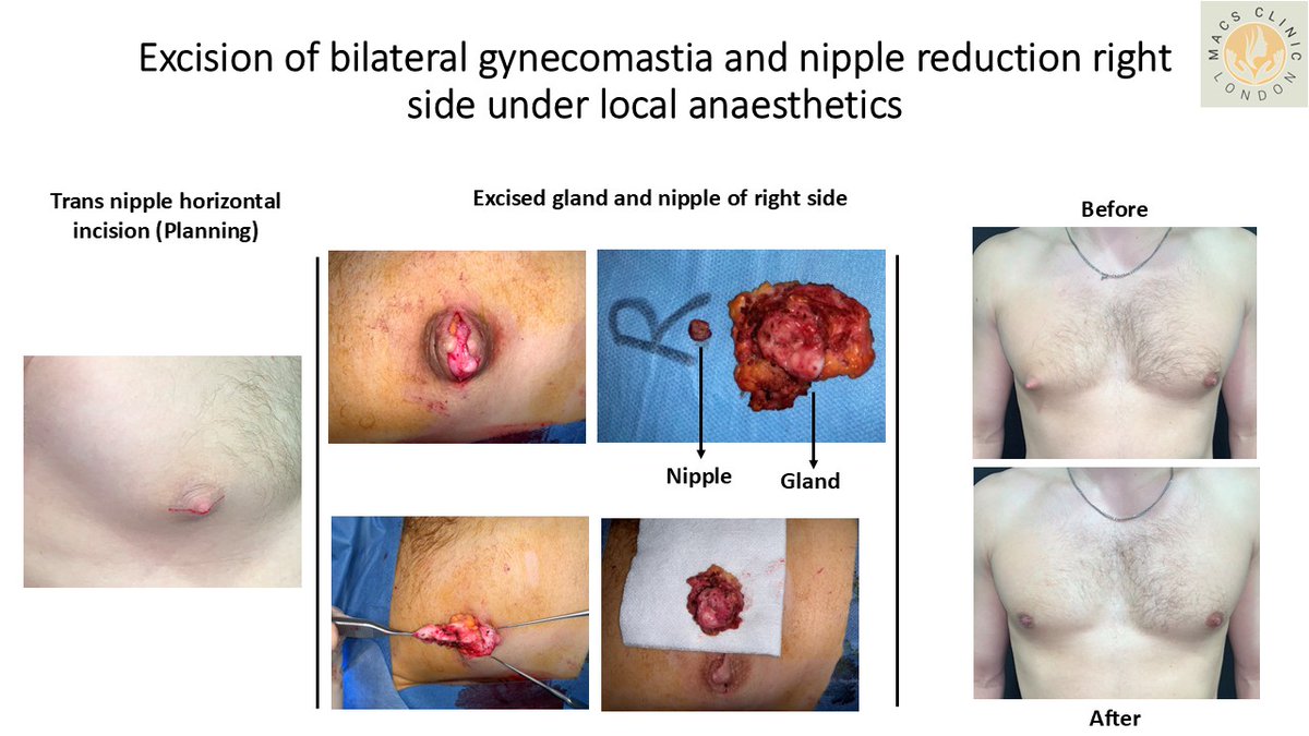 MedicalArtsCS's tweet photo. ✨ **Excision of Bilateral Gynaecomastia &amp; Right Nipple Reduction Under Local Anaesthetic** ✨

📞 **Contact Us**
☎️ 020 7078 4378
📱 WhatsApp: 07792 648726
📧 [enquiries@macsclinic.co.uk]
📍 Unit 3, Wilmington Close, Watford WD18 0AF
🌐 [https://t.co/LztStxUCrt] https://t.co/nh8APFKc8z