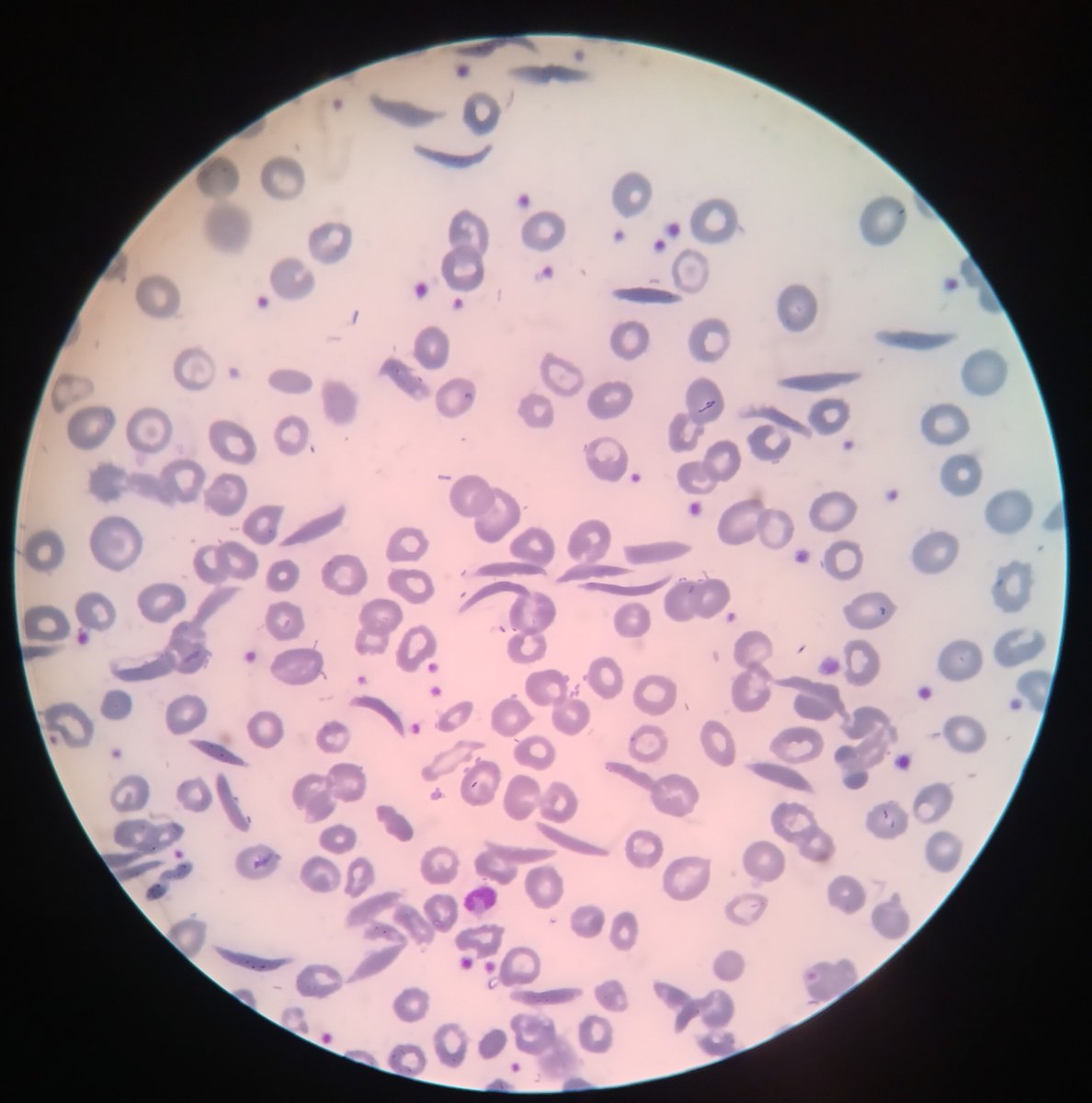 KushabaDaniel3's tweet photo. Those who dont know about  sickle cell disease,ts advisable you test as couples before producing kids ,in that picture below that's how yo cells be like (moon shaped),ts serious  illness en can be avoided, Jayden will be fine en cells will be normal we pray for quick recovery https://t.co/t12HU8cSVS