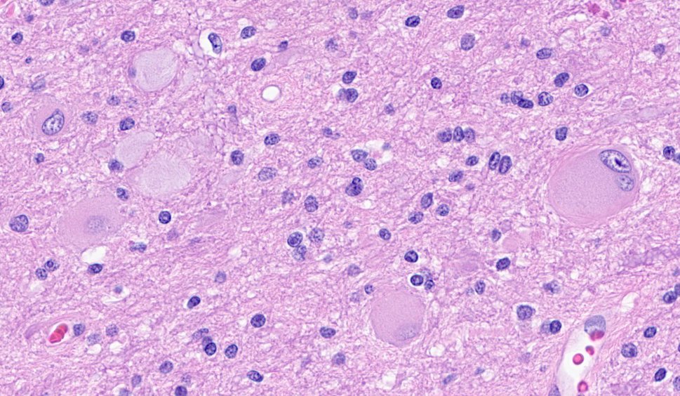 CraigHorbinski's tweet photo. What do we call the big cells in this frontal white matter region from a patient with intractable epilepsy? (Hint: 🎈) #pathology #neuropath #pathtwitter https://t.co/8XexLwdWJE