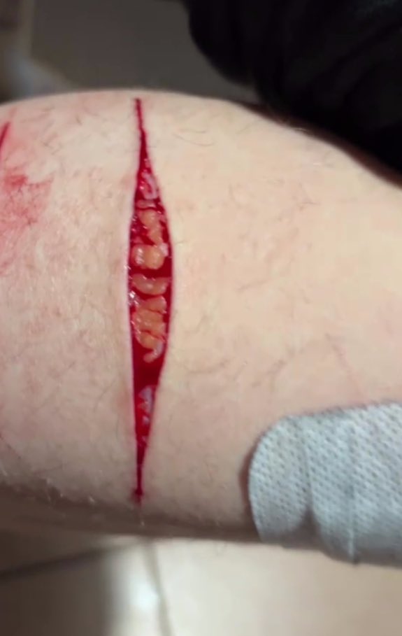 Jamf313's tweet photo. Beans on calf 

SFX MAKEUP!!! Not real!! 
#shedtwt https://t.co/afkqo8ajOQ
