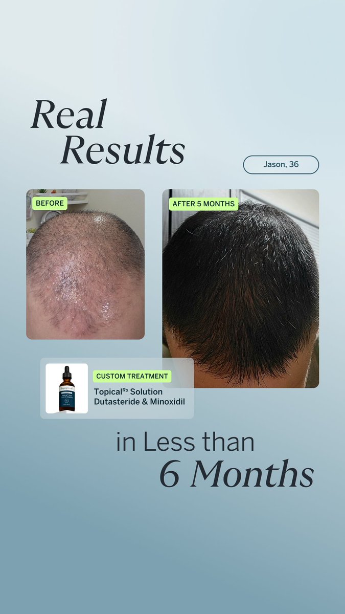 HiHappyHead's tweet photo. 🚨 Tired of hair loss? Get the strongest FDA-approved ingredients delivered discreetly to your door!