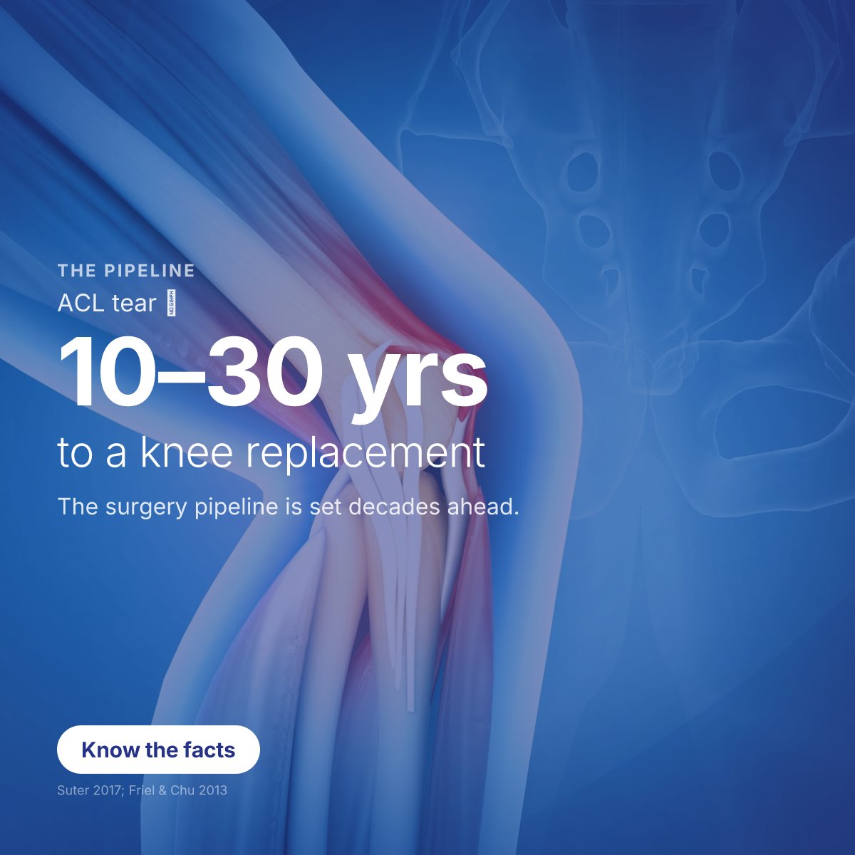 biosplice's tweet photo. A young athlete tears their ACL today. In 10–15 years, many face arthritis. In 20–30 years, many face a knee replacement. The surgery pipeline is set decades in advance. #KneeOA https://t.co/X3K7vmLmvp