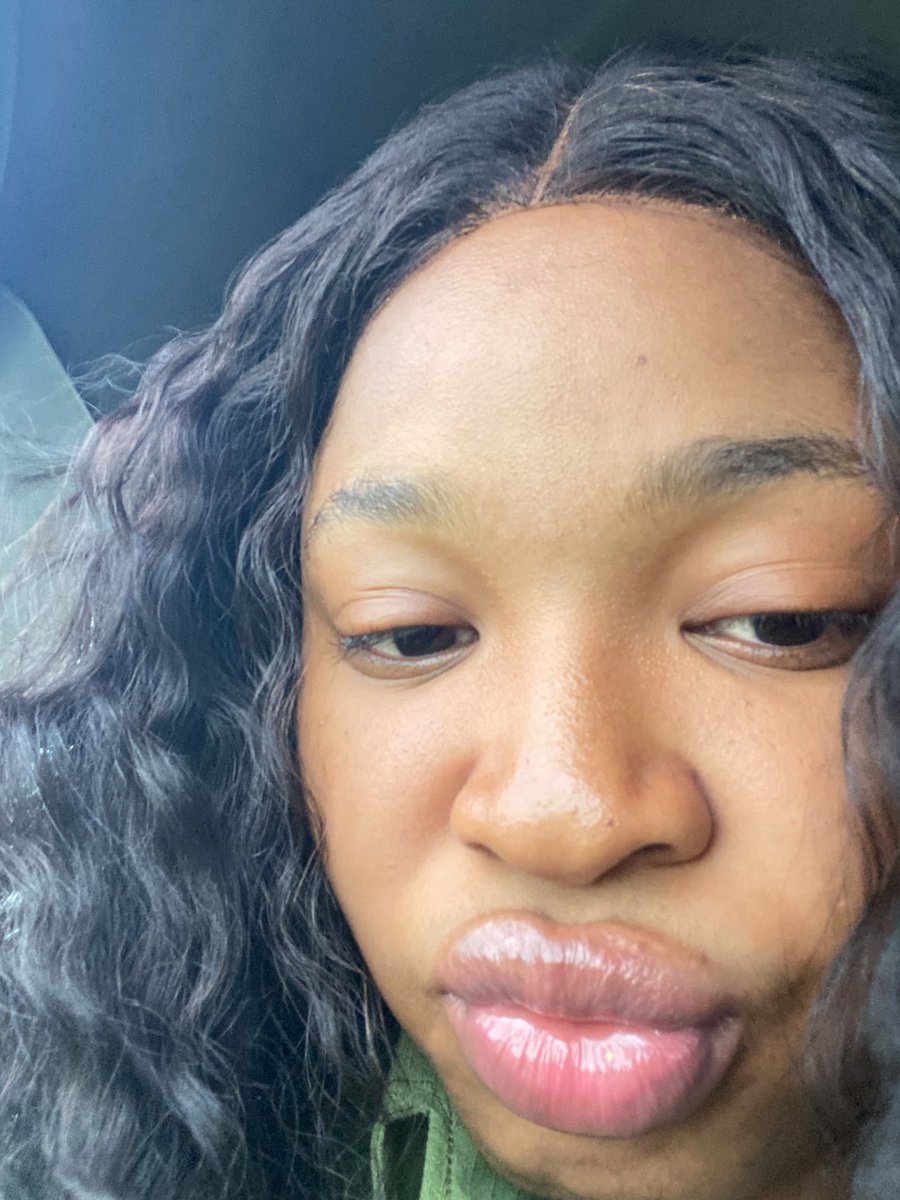 vspbotanics's tweet photo. News flash!!!

Glycolic acid does not only Exfoliate the skin. Pair glycolic acid exfoliant with Potassium Azeloyl diglycinate and a moisturizer, you’ll be treating Tinea versicolor, pityriasis alba, idiopathic guttate hypomelanosis. 

Results from numerous users have shown that this is a more sustainable and effective alternative to steroids in the treatment of some of these benign skin conditions 

#skinconditions #skinconcerns #explore #glycolicacid