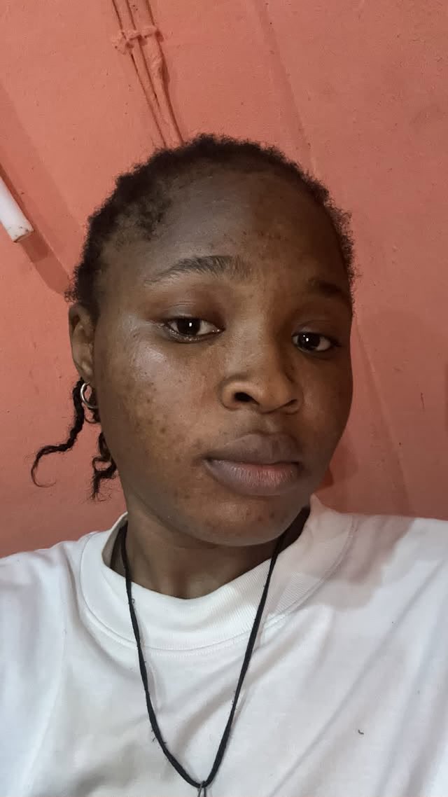 vspbotanics's tweet photo. News flash!!!

Glycolic acid does not only Exfoliate the skin. Pair glycolic acid exfoliant with Potassium Azeloyl diglycinate and a moisturizer, you’ll be treating Tinea versicolor, pityriasis alba, idiopathic guttate hypomelanosis. 

Results from numerous users have shown that this is a more sustainable and effective alternative to steroids in the treatment of some of these benign skin conditions 

#skinconditions #skinconcerns #explore #glycolicacid