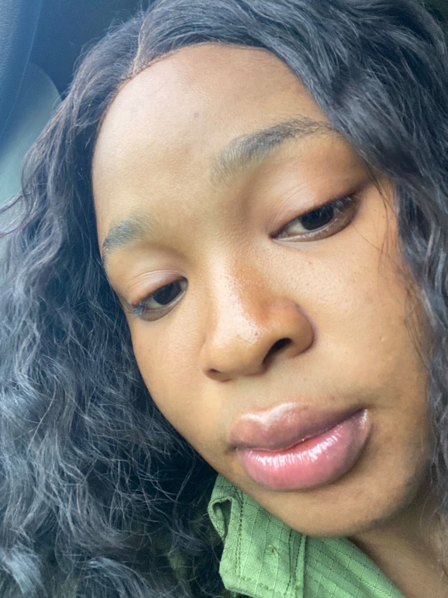 vspbotanics's tweet photo. News flash!!!

Glycolic acid does not only Exfoliate the skin. Pair glycolic acid exfoliant with Potassium Azeloyl diglycinate and a moisturizer, you’ll be treating Tinea versicolor, pityriasis alba, idiopathic guttate hypomelanosis. 

Results from numerous users have shown that this is a more sustainable and effective alternative to steroids in the treatment of some of these benign skin conditions 

#skinconditions #skinconcerns #explore #glycolicacid