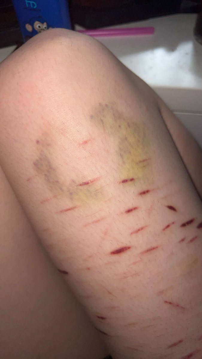 g0recake_rin's tweet photo. I loooove bites more people should bite me i love the feeling and the bruise haaaaah bite me please໒꒰ྀི∩˃ ᵕ ˂∩꒱ྀི১
#sh #shtwt #bitemark #bite #bitebruise #bruise #bruisedskin #bruisedthigh #biteme https://t.co/F7A0rVj6nm
