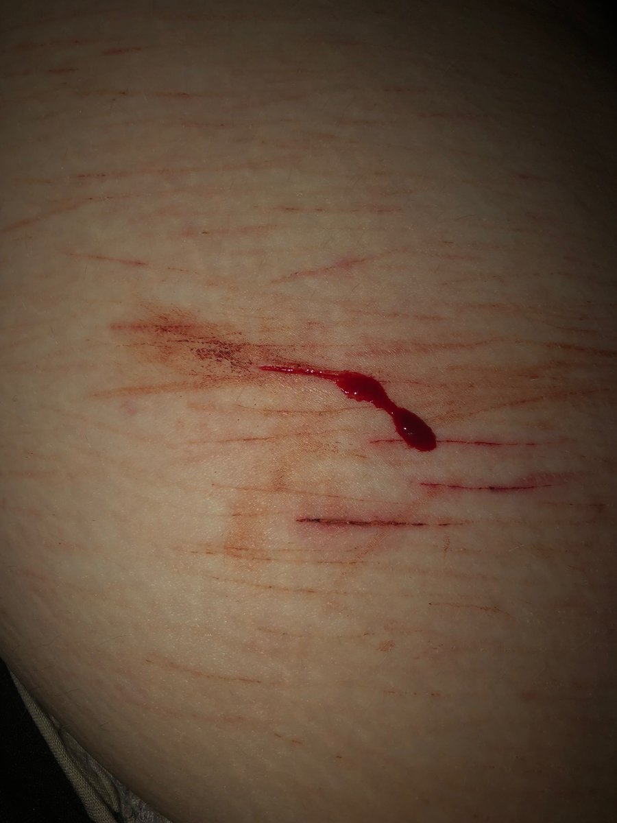 XianxiaX3's tweet photo. It actually wont stop bleeding like omg bro, also this blood rag is so absorbent bc look at the lack of blood on there (i admittedly spent 4 hours just hacking at this to make it like that, i wish i could one swipe)
ALL FAKE SFX MAKEUP NOT REAL
#slitwt #shedtwt #shtwt #sledtwt https://t.co/QzFC1FZl82