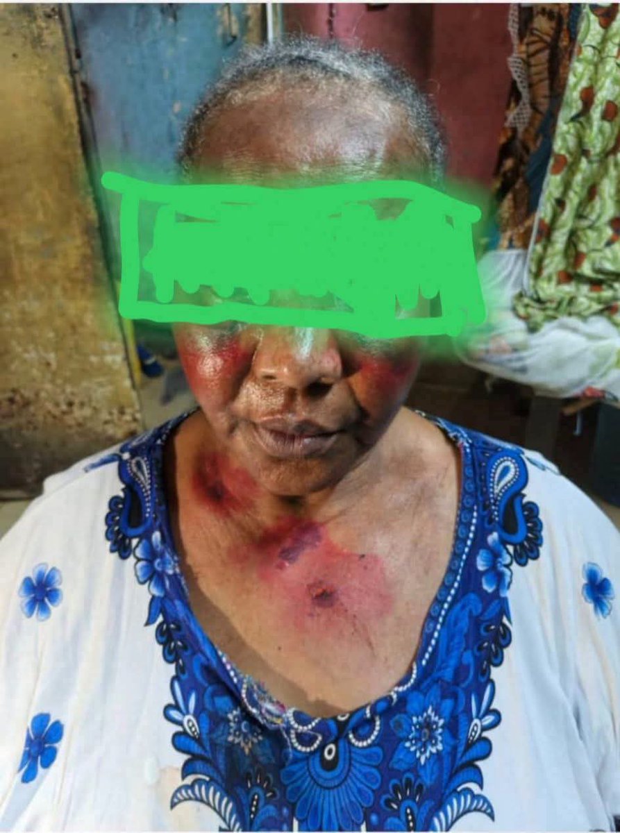 ZonePresse_'s tweet photo. ⚠️ « Cinq ans à la MACA sans jugement. Malade et bastonnée (…) » : un internaute dénonce la situation dévalorisante de sa mère âgée de plus de 60 ans, en prison en Côte d’Ivoire 🇨🇮

« Ma maman mm est à la MACA. Pour une affaire d'argent. On est dans la 5eme année... Sans jugement. Tension, diabète, etc. Elle est malade. On lutte pour qu’elle reste en vie. Notre problème ce n'est même pas qu'elle ait raison ou pas. On veut juste qu’elle soit jugée. Ou si ce n’est pas possible, qu’elle soit purement et simplement relaxée provisoirement comme le stipule la loi. Elle s'est plusieurs fois faite agresser en prison. Bastonnée, blessée par ses codétenues. On parle d'une femme qui a plus de 60 ans. 

Bref. Un jour, ça va péter dans ma tête, je vais commencer un pressing (…). Il faut que ça cesse. Si vous ne pouvez pas gérer tous les cas que vous avez, bah n'arrêtez pas les gens alors pour les remplir à la MACA et les laisser là sans jugement. Même pour te juger encore c’est problème. C'est hallucinant. Où je vous parle elle revient de 2 semaines d'hospitalisations... après un malaise. La dame est malade. Vous ne la libérez pas. Vous ne la jugez pas aussi. On la bastonne en prison. Regardez-vous même…Si la femme la meurt en prison là-bas... vous allez prendre tous les Diomande là pour les déposer à la MACA la bas....

Parce que toutes les télécommandes que je connais. Tous les influenceurs que je connais. Toutes les télés que je peux allumer, je vais allumer sur vous et walahi vous n'êtes pas prêts (…) »