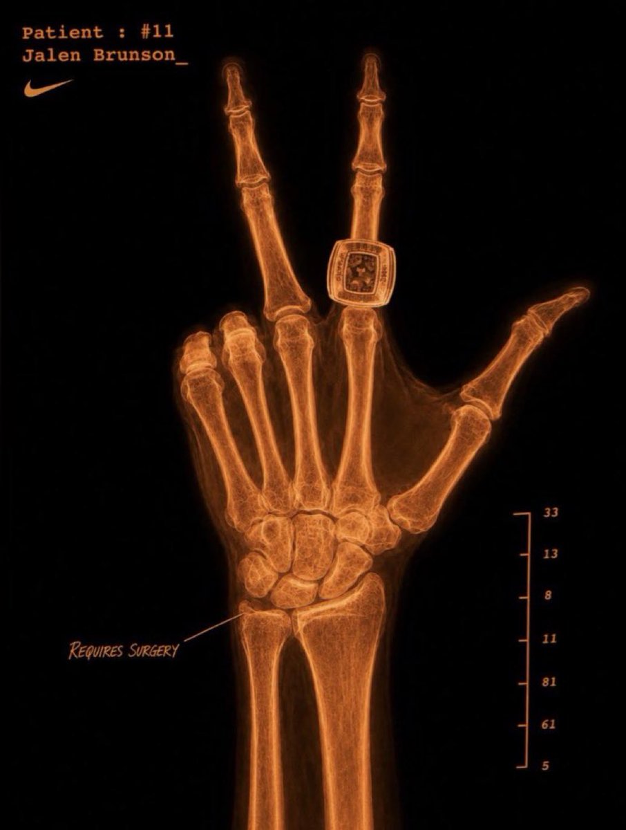 NBAMemes's tweet photo. Jalen Brunson’s wrist surgery x-ray has been revealed 😮‍💨🔥 https://t.co/vNRImmf6gL