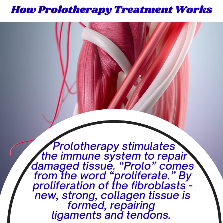 TheAthleticDoc's tweet photo. Prolotherapy stimulates the immune system to repair damaged tissue. “Prolo” comes from the word “proliferate.” By proliferation of the fibroblasts - new, strong, collagen tissue is formed, repairing ligaments and tendons. https://t.co/TPEEt0k8wA https://t.co/AgubGrjzx3