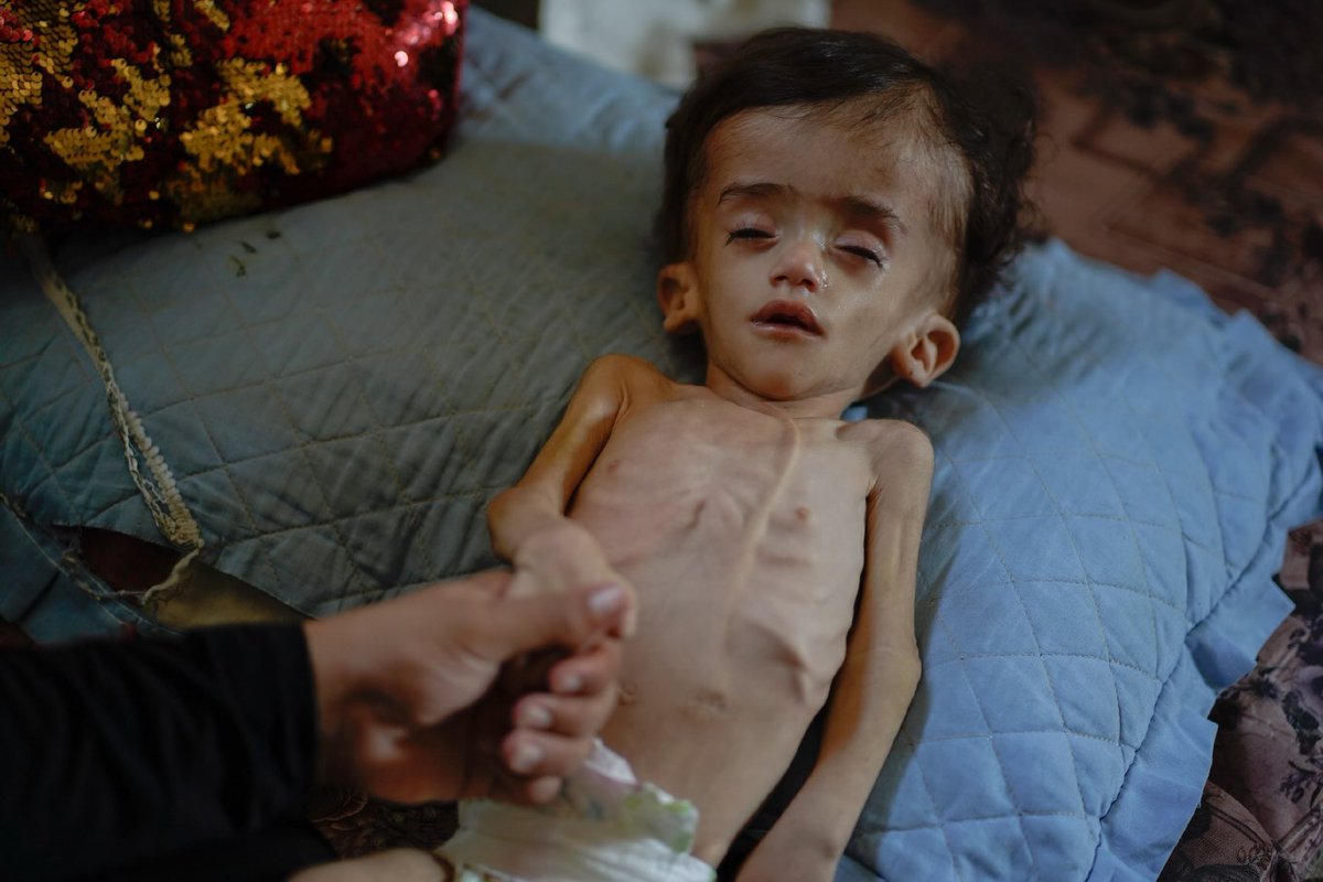 Timesofgaza's tweet photo. The health of one-year-and-three-month-old Issam Al-Nabih has deteriorated critically due to severe hydrocephalus that has caused an enlarged head. His condition requires urgent travel outside the Gaza Strip to receive specialized medical treatment, as the necessary care is unavailable locally. Any delay in securing his transfer poses a direct threat to his life, making immediate intervention essential before it is too late.