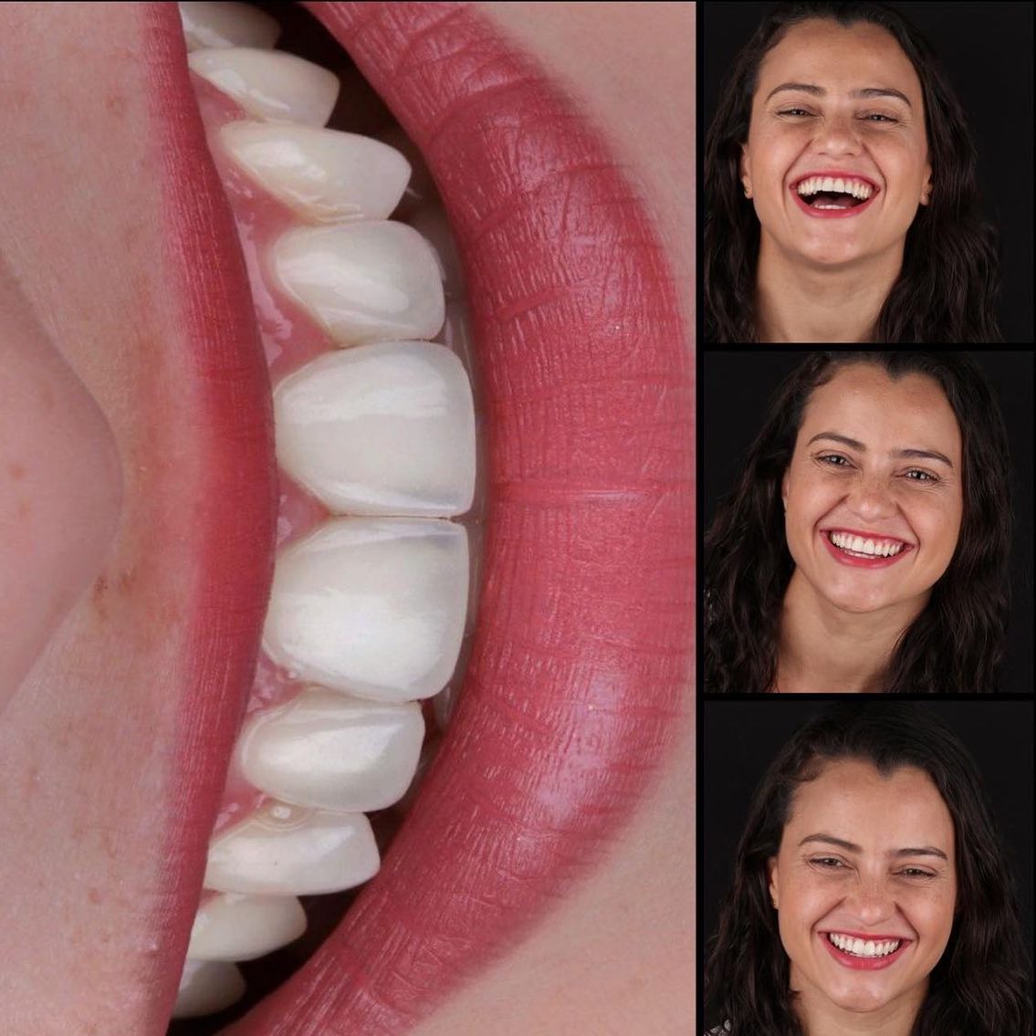 Wendy08034's tweet photo. Wow, that smile is truly heartwarming! On the left is a close up of her teeth after the procedure   just look at that color and alignment!
On the right is how she smiles now; it’s a total transformation! She went from being hesitant to laugh out loud to smiling so happily and naturally. It’s so rewarding! Seeing patients gain this kind of confidence makes being a dentist absolutely worth it what do you think?
Is it the whiter, straighter teeth that impress you most, or the confidence she radiates? Let me know in the comments   what s the one thing  you  d  most like to improve about your own smile?
(Color? Shape? Or maybe the fear of smiling?) #SmileMakeover #TeethWhitening #ConfidentSmile