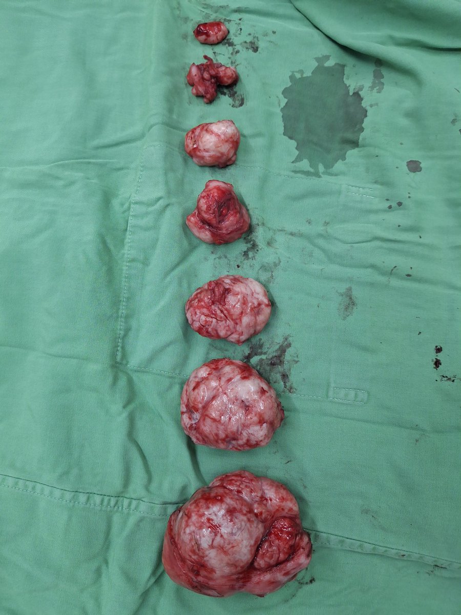 mpang636's tweet photo. Konten edukasi ⚠️
Hasil Miomektomi ec Multiple Mioma Uteri dari pasien perempuan usia 47 tahun
Buat teman2 yg cewe perhatikan pola makanannya ya, segera berobat jika terdapat keluhan nyeri perut menahun dan haid tidak teratur agar diberikan penanganan. Deteksi dini lebih baik. https://t.co/8hu5xjZXIB