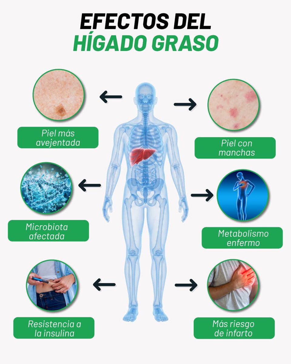 BajaEquipo's tweet photo. Cuando el hígado acumula exceso de grasa, su funcionamiento puede verse comprometido y esto repercute en distintos procesos del organismo.

💚 La buena noticia es que el hígado graso puede mejorar con cambios en la alimentación, actividad física, un buen descanso. https://t.co/1ZjD7TndXF