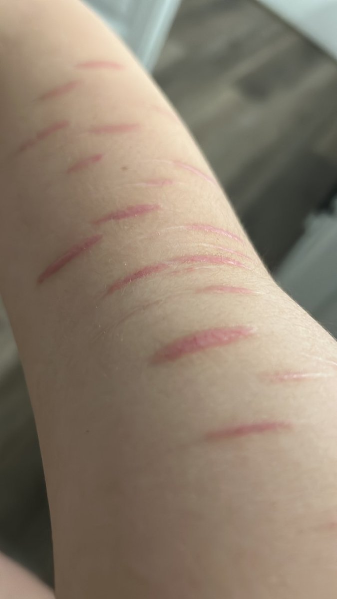 choppedbunny's tweet photo. my scars ^-^
[ALL FAKE SFX!!] https://t.co/tFEVGtEi8c