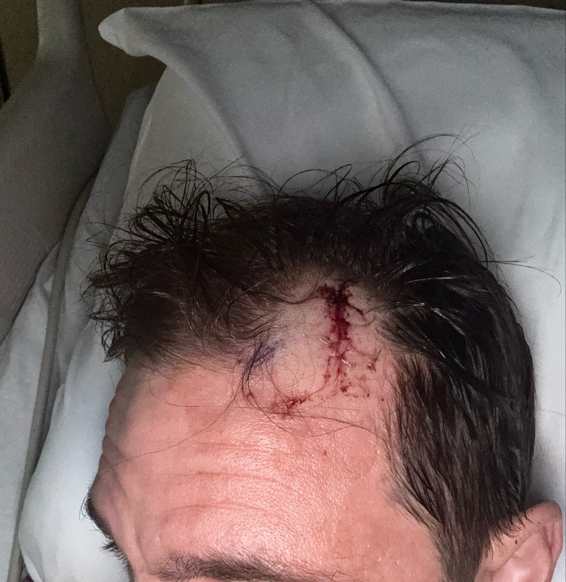 southtexasterp's tweet photo. Have not posted here in a bit. Just thought I’d update everyone. I had a brain biopsy today and everything went well. Now we wait on samples and then try to shrink the tumor. Since it’s growing from my left side we couldn’t do surgery due to that side being  my motor functions. https://t.co/pRp6hTCaD2