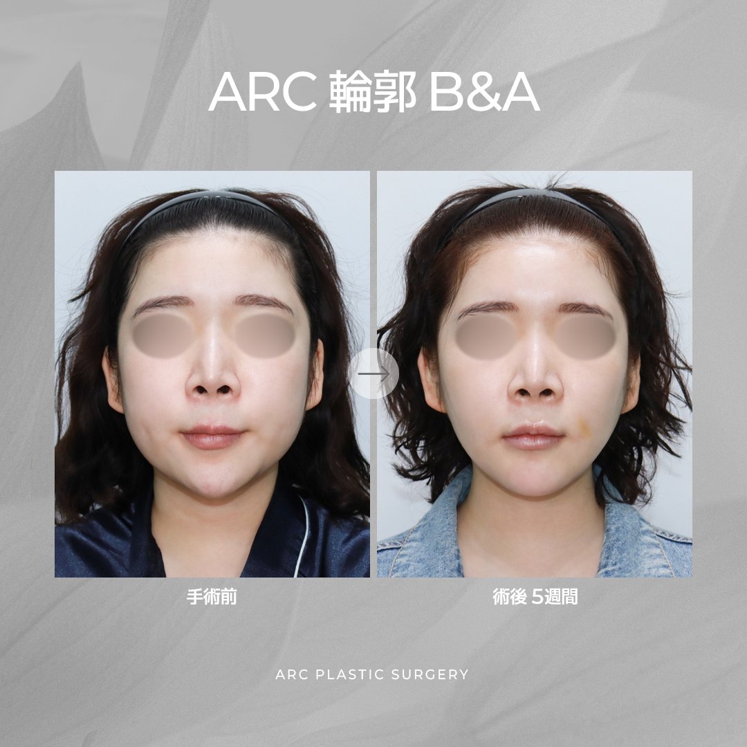 ARC_ps_'s tweet photo. ＼＼ ARC 5周年EVENT解禁 �� ／／
輪郭専門『クォン代表院長』の
トータル輪郭3点パッケージがついに…🔥
『頬骨縮小＋エラ＋顎先』
さらに
『皮質骨切除＋咬筋縮小＋バッカルファット除去』まで含めて
🎯『899万ウォン』🎯

術後5週間でも、正面の余白感・横顔のフェイスラインに変化🦴✨
骨格から整えるから、輪郭の印象が一気に垢抜ける。

🎉EVENT詳細🎉
💎今年中に手術を受けられる方
💎『20名様限定』
💎すべて『部分モニター価格』
💎枠が埋まり次第、予告なく終了する可能性あり

詳しくはLINE💌https://t.co/S0uJiuoIUh
#韓国整形 #輪郭3点 #頬骨縮小 #エラ削り #顎先手術 #ARC美容整形外科
