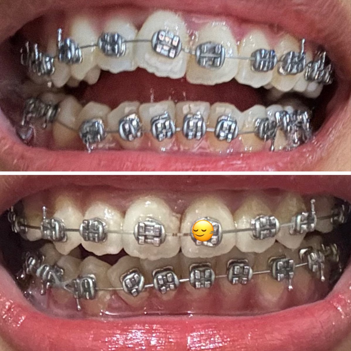 tsnnie's tweet photo. agak menjijikan tpcso happy progress behelku kurleb 3 bulanan😭 love dr orthoku🤭🩷 https://t.co/Tor0yhEFC8