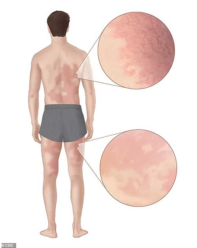 OwenGregorian's tweet photo. Outcry as scientists push to create ticks spreading meat allergies | Chris Melore, Daily Mail

A recently unearthed study has set off a tidal wave of outrage after scientists claimed it was 'morally' justifiable to infect people with a virus making them allergic to meat.

Researchers Parker Crutchfield and Blake Hereth from Western Michigan University published an inflammatory paper in 2025, making the case that society had a moral 'duty' to spread ticks that were infected with or engineered to carry alpha-gal syndrome (AGS).

AGS is a real medical condition transmitted to humans through tick bites, causing victims to suffer allergic reactions when eating red meat, including beef, pork and lamb, dairy and other products derived from mammals.

The symptoms can range from a mild case of hives or stomach pain to severe and even life-threatening cases of anaphylaxis - where blood pressure suddenly drops and the person becomes unable to breathe as their airways swell up.

Crutchfield and Hereth claimed that it was morally wrong to eat meat because of the suffering animals endure and the environmental damage that the meat industry allegedly causes.

They argued that the only reason society should not be spreading ticks to infect people with AGS today is that scientists do not currently have an easy and effective way to do it on a large scale.

However, they added: 'But it is feasible to genetically edit the disease-carrying capacity of ticks. If we are right, then today we have the obligation to research and develop the capacity to proliferate tickborne AGS and, tomorrow, carry out that proliferation.'

One critic of the study replied: 'Isn't this biological terrorism? Shouldn't they be thrown in jail?'

The study authors did not conduct any medical experiments or new research to back up their claims, calling their paper a work of philosophy, using ethical reasoning from different moral theories and assuming that meat-eating is bad.

Their main findings were that promoting genetically modified ticks to spread AGS would make the world better and help people become more 'virtuous' by avoiding meat.

They also claimed that this process would not violate anyone's rights, despite proposing to intentionally infect the population with a life-threatening infection.

AGS is triggered by a bite from the lone star tick, a breed of the parasite found throughout the US from Texas to the East Coast.

When a tick bites someone, it injects alpha-gal sugar into the person's body, causing the immune system to develop antibodies that attack it.

Between 2017 and 2022, the CDC reported about 90,000 suspected cases of AGS, and the number of new suspected cases increased by approximately 15,000 each year. The agency has estimated that as many as half a million Americans have AGS.

It can also complicate medical treatments involving mammal-based ingredients in certain medications, vaccines or surgical materials. There is currently no cure, and the tick-transmitted illness requires lifelong avoidance of meat-based products.

'Intentionally inflicting a debilitating disease on people is a horribly vicious crime and should get the strongest possible penalty,' another person added on social media.

The Western Michigan University Homer Stryker MD School of Medicine defended the paper, published in the journal Bioethics, calling the researcher's conclusions 'a thought experiment.'

In a statement to the fact-checking website Snopes, the school wrote: 'Thought experiments are a long-established and legitimate philosophical method.'

'Their purpose is to examine the implications of ethical commitments and to surface hidden assumptions so they can be scrutinized. They are neither policy proposals nor clinical recommendations.'

However, the reaction from the public has been fierce, with critics blasting the authors for claiming that meat eaters should be infected with a disease to prevent them from eating meat.

'Anyone who works to spread alpha-gal should be tried for crimes against humanity,' one commenter on X said.

'Who decided it was "morally" wrong to eat meat? Humans are not herbivores,' another person added.

Despite the study's claims that spreading diseases through ticks was only a philosophical experiment, scientists have claimed that the CIA has already been using ticks as weapons for decades.

Dr Robert Malone, who helped lay the groundwork for mRNA vaccine technology, claimed he analyzed declassified government documents from Cold War biological weapons programs that link the spread of Lyme disease to CIA experiments.

Malone highlighted experiments in the 1960s that allegedly released more than 282,000 radioactive ticks in Virginia and open-air tick research at Plum Island, a federal laboratory located near the Connecticut community where Lyme disease was first identified.

Malone’s report argued the research was part of a much larger Cold War biological weapons program known as Project 112, which involved dozens of secret tests aimed at studying how insects could be used to spread pathogens.

Meanwhile, Google is currently facing backlash over plans to release millions of bacteria-infected mosquitoes in two states, allegedly to reduce mosquito populations.

Backed by Google's parent company Alphabet, the proposal is seeking federal approval to deploy 32 million modified mosquitoes annually across California and Florida beginning in 2027.

If approved, the two-year program would result in a total of 64 million mosquitoes being released into the environment.

The aim is to reduce populations of disease-carrying mosquitoes using what researchers describe as 'good bugs' - males carrying a naturally occurring bacterium called Wolbachia. Male mosquitoes also do not bite.

When the infected males mate with wild females, the females still lay eggs, but the eggs fail to develop and hatch, which would theoretically kill off new waves of disease-carrying pests.

https://t.co/zWagP2CKXY