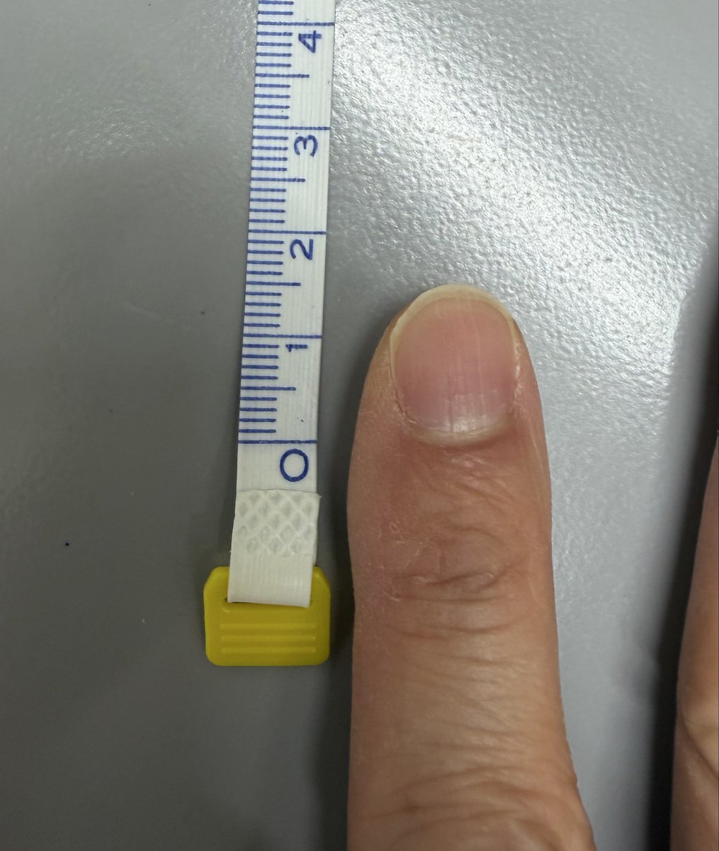 VetCardSurgeon's tweet photo. 1kg台前半の犬の僧帽弁前尖長は10mm程度で、私の爪より小さいです😓

ここに腱索4対建ててます🪡 https://t.co/bxlU8AXsrJ