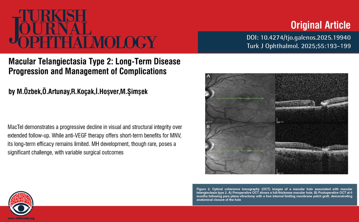 TurkJOphthalmol's tweet photo. Macular Telangiectasia Type 2: Long-Term Disease Progression and Management of Complications
You can see the free full text of the research by Merve Özbek et al.
Link : https://t.co/udENHysF11
#Macular #telangiectasia #type2 #macular #neovascularization #macularhole https://t.co/zPnFgbJ4A3