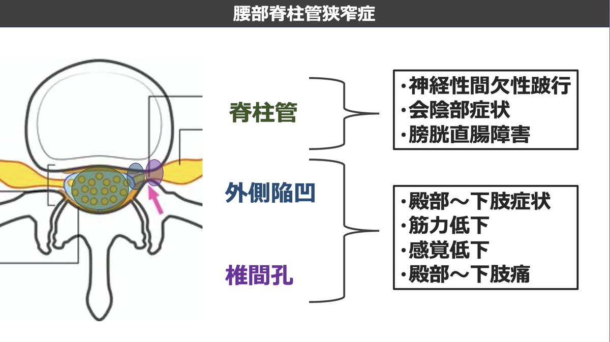 mori_pt_gbc's tweet photo. 腰部脊柱管狭窄症の症状をまとめました。 
脊柱管内における狭窄と、外側陥凹・椎間孔における狭窄で症状が大きく異なります。 
臨床の一助になれば幸いです。         

セミナー参加はこちらから   
https://t.co/m6jgBd9tY4 https://t.co/vllRGgesq8