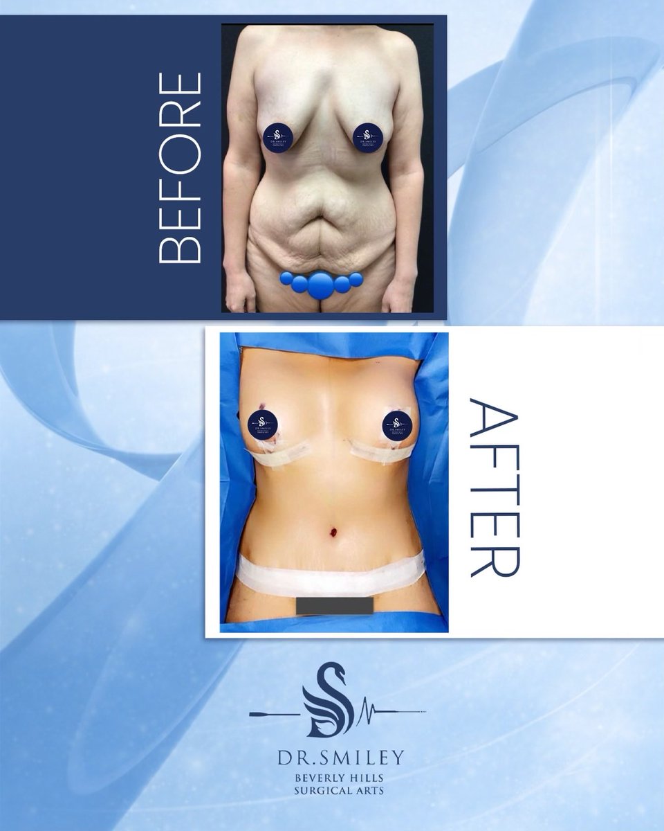 drsmiley_t's tweet photo. Having your dream body isn’t a dream anymore!
Dr.Smiley
For consulting and reservation:
📞 Call us today: 1-866-372-3288 (Beverly Hills) | +971-50-505-3131 (Dubai) | +961-71-707-140 (Beirut) | +966-50-545-3131 (Saudi Arabia)
#DrSmiley #PlasticSurgery #Confidence #beverlyhills https://t.co/YFTNN750Be