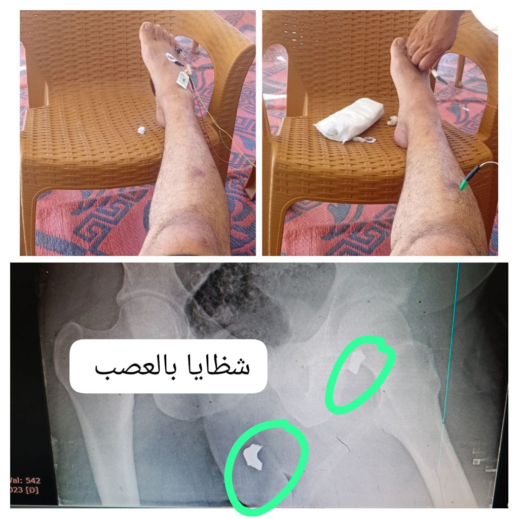 mmgh2023's tweet photo. 🚨 أنقذوا قدمي من العجز

أنا الجريح إبراهيم خليل المقدمة من #غزة. مصاب بشظايا في العصب الوركي تسببت بسقوط قدمي اليمنى. أحتاج جراحة عاجلة بالخارج لإنقاذ العصب قبل فوات الأوان.
📱 واتساب: 00970599959136
#انقذوا_الجريح_ابراهيم_المقدمة
@Spokesman_Pres @EgyAMR @emiratesrc @WHO https://t.co/simScQw5OJ