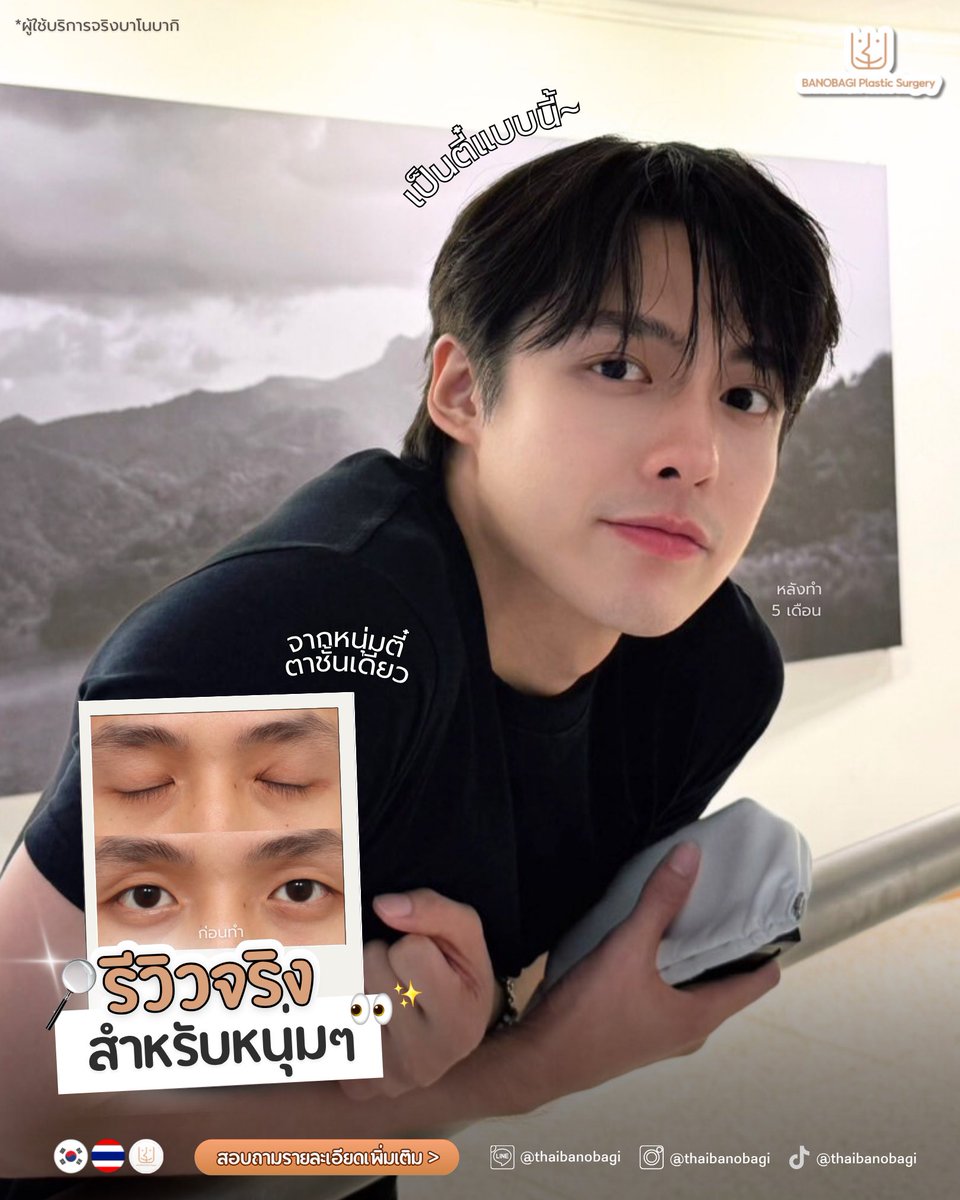 banobagithai's tweet photo. อีกหนึ่งเคสตาผู้ชายที่หลายคนถามถึง 👀 
ผลลัพธ์หลังฟื้นตัวเป็นลุคธรรมชาติ ดูสดใสขึ้น
ขอบคุณคุณเฮง  ที่ไว้วางใจให้บาโนบากิดูแลนะคะ 🙏✨

#ศัลยกรรมเกาหลี #บาโนบากิ #ตาสองชั้น  #ปรับกล้ามเนื้อตาแบบไม่กรีด  #ศัลยกรรมผู้ชาย #อย่าขอพี่เจน https://t.co/q6jgfpuI9q