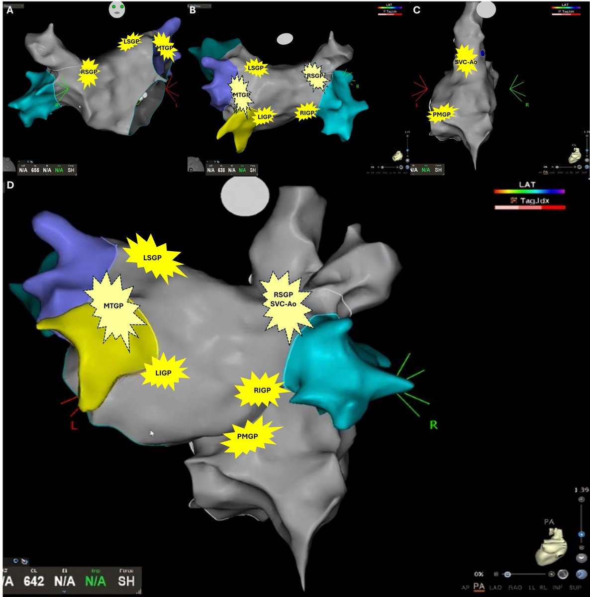 RCMjournal's tweet photo. 🫀 Cardioneuroablation: pacemaker alternative for VVS.

📊 Syncope recurrence: 5.9% post-CNA vs 54% standard care
📊 97% avoid pacemaker in AV block
📊 Complications <1%
💡 For young patients, CNA may beat lifelong pacing.

🔗https://t.co/mGemsF2kWq

#Cardiology https://t.co/Eou1dGA9x3