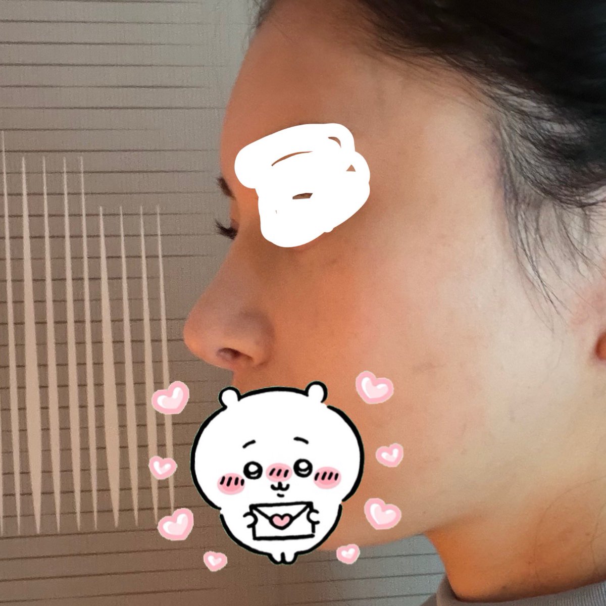 ch__xxy's tweet photo. wave美容外科さんで鼻フル修正して9ヶ月が経ちました！
自家肋軟骨を使用しましたが傷跡も気にならず鼻もかなり安定しています。
写真映りも鼻のおかげで良くなり満足しています🥹
両顎で崩れてしまった鼻と比べてACRも整い忘れ鼻に近くなり本当に綺麗になりました！
左術前、右術後
@bewavejp https://t.co/59v8GnIQqy